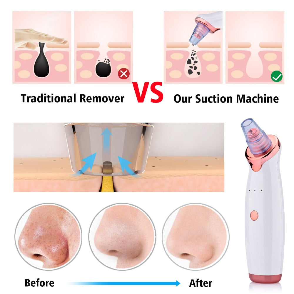 PuraSuction Dermaclen™